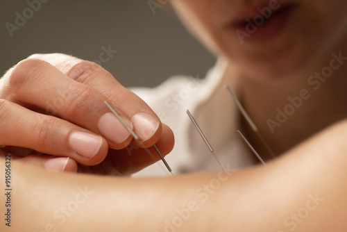 Acupunturist treating patient chronic back pain photo