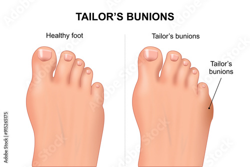 Tailor's Bunions Foot Illustration