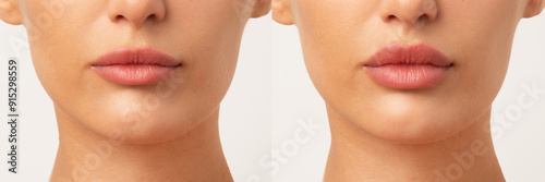 Obraz na płótnie Collage of young woman before and after lips augmentation procedure, white studi