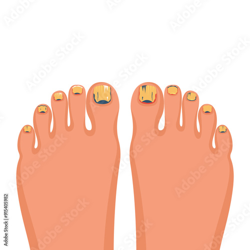 Nail disease. Onychomycosis concept. Fungal nail infection. Paronychia is inflammation of the skin around the toenail. Fungal disease, psoriasis. Vector illustration flat design.