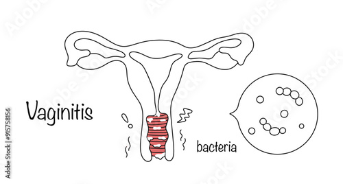 Vaginitis