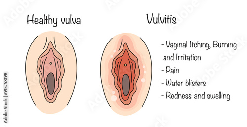 Vulvitis