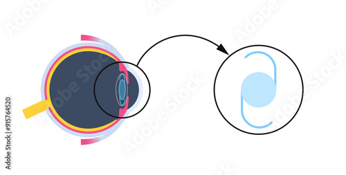 Intraocular lens poster