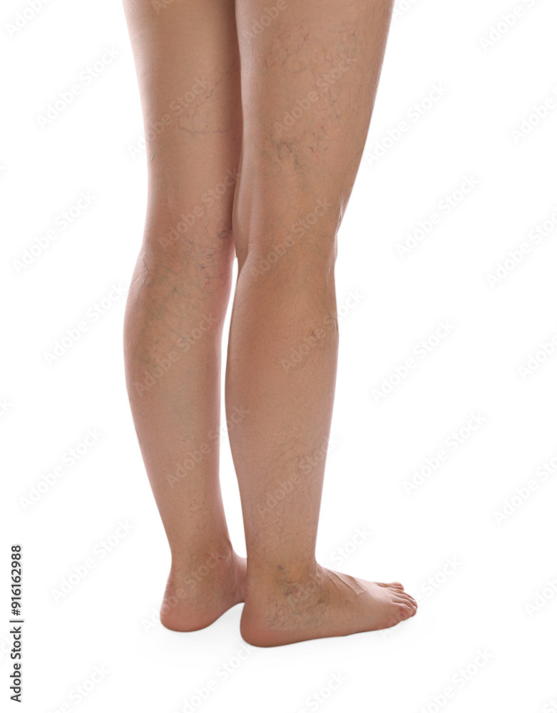 Woman with varicose veins on white background, closeup Woman with varicose veins on white background, closeup
