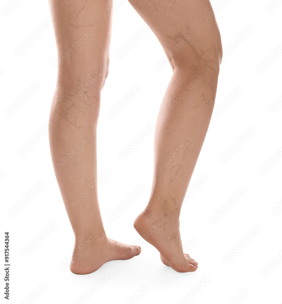 Woman with varicose veins on white background, closeup Woman with varicose veins on white background, closeup