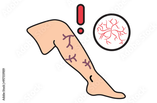A venous leg ulcer is a chronic, slow-healing sore on the lower leg caused by poor blood circulation due to venous insufficiency. Related diseases: varicose veins,deep vein thrombosis, lymphedema