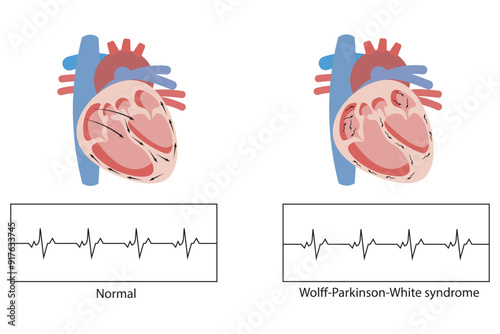 Wolff-Parkinson-White syndrome ,heart condition causing rapid heartbeats due to an extra electrical pathway,atrial fibrillation, supraventricular tachycardia,sudden cardiac arrest.
