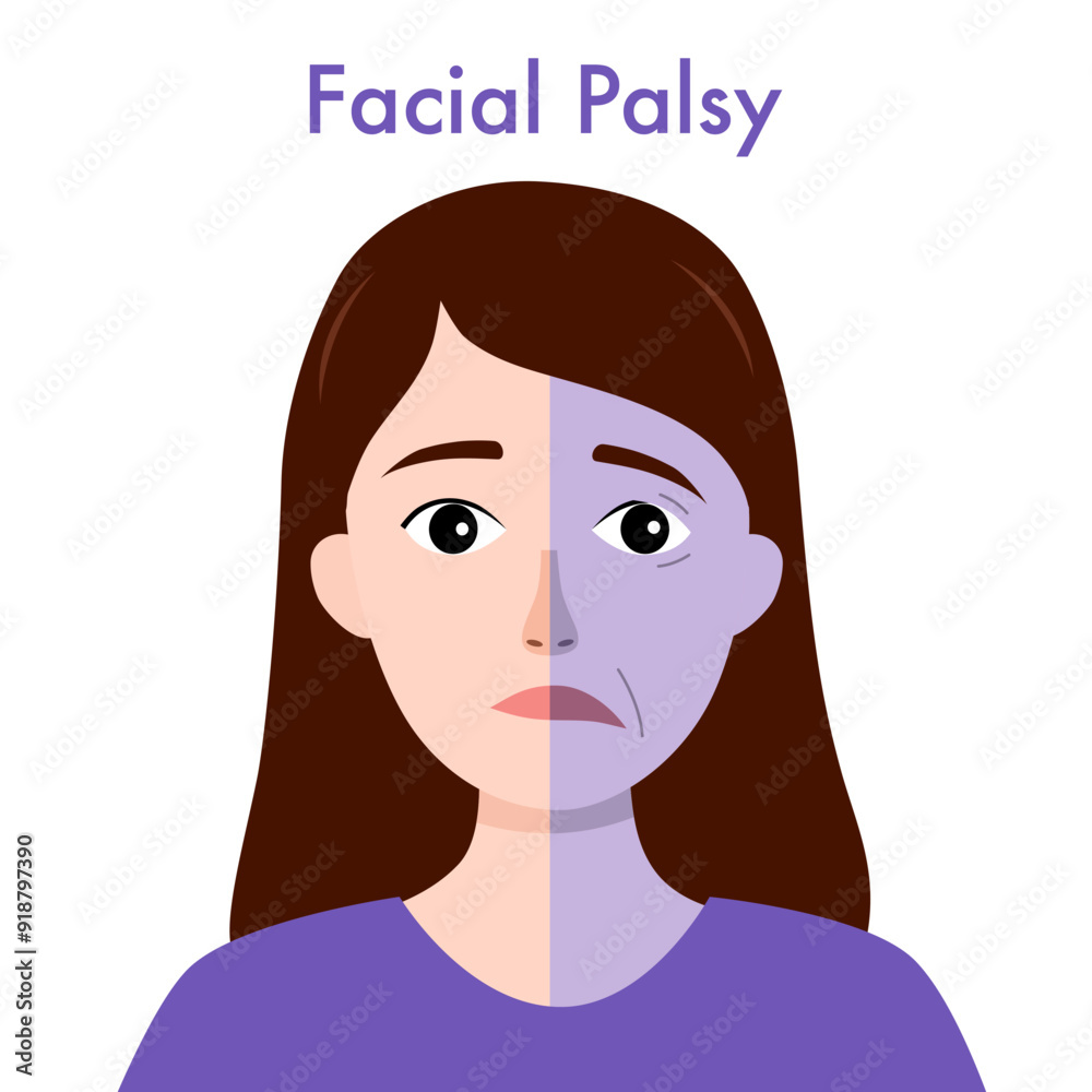 Facial palsy. Male character with asymmetrical face, nerve damage. Drooping smile. Facial palsy. Male character with asymmetrical face, nerve damage. Drooping smile.