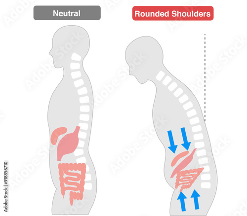 Comparison of people whose internal organs are compressed due to poor posture caused by a Rounded Shoulders.