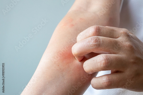 Foto Young asian man itching and scratching on arm from allergic itchy dry skin eczem