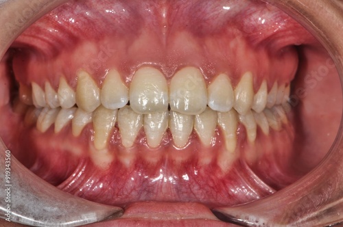 Close-Up of Adult Human Teeth and Gums