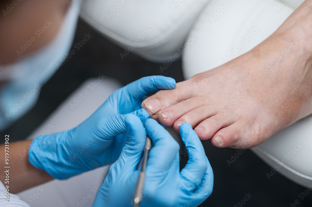 Foto The podologist cleans the patient's nail using a curette tool