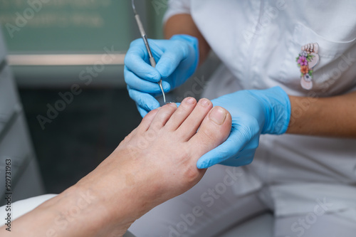 The podologist cleans the patient's nail using a curette tool. Patient on medical pedicure procedure, visiting podiatrist. Peeling feet. Foot treatment in SPA salon.Podiatry clinic photo