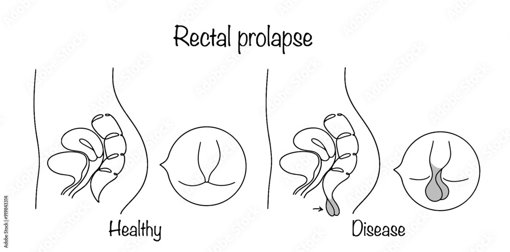 Rectal prolapse Rectal prolapse