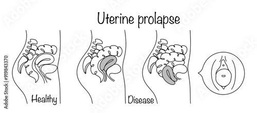 Uterine prolapse