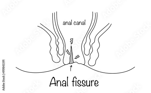 Anal fissure