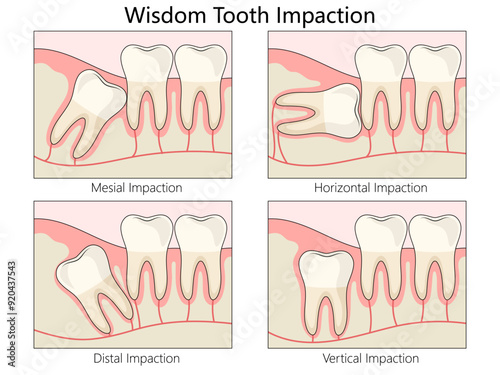 wisdom tooth impaction. mesial, horizontal, distal, and vertical, highlighting different dental conditions diagram hand drawn schematic vector illustration. Medical science educational illustration
