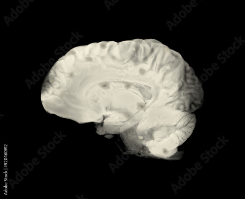 Sagittal View of Brain Showing MS-Related Albumin Leakage photo