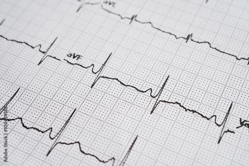 Electrocardiogram (ECG), heart wave, heart attack, cardiogram report.