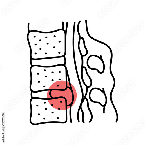 Intervertebral hernia 
disc color line icon. Diseases of the spine