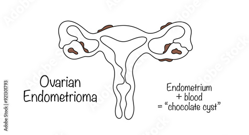 Ovarian Endometrioma