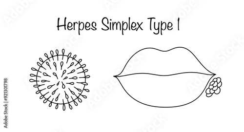 Herpes Simplex Type 1