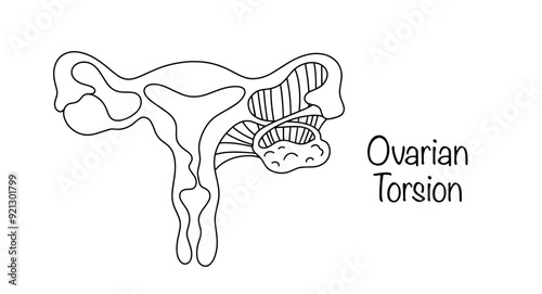Ovarian Torsion