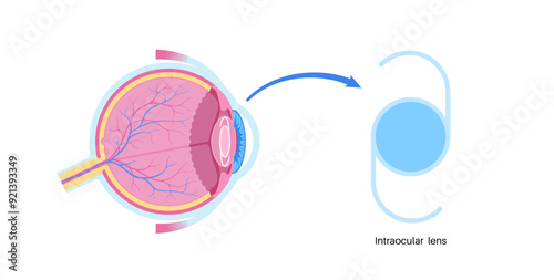 Intraocular lens poster