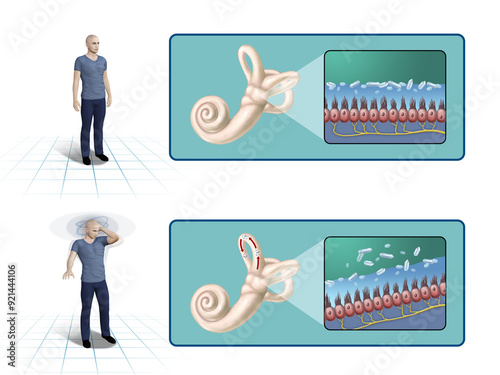 Benign paroxysmal positional vertigo