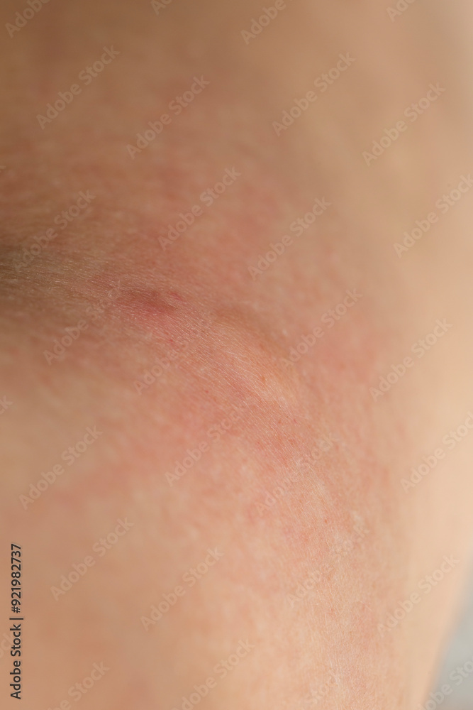 Fototapeta premium Inflamed human skin after a mosquito bite.