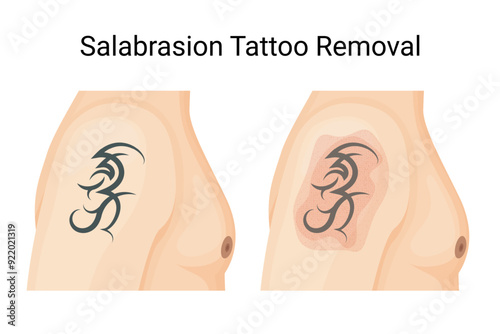 Salabrasion Tattoo Removal, Traditional Non-Laser Method