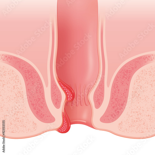 外痔核と内痔核