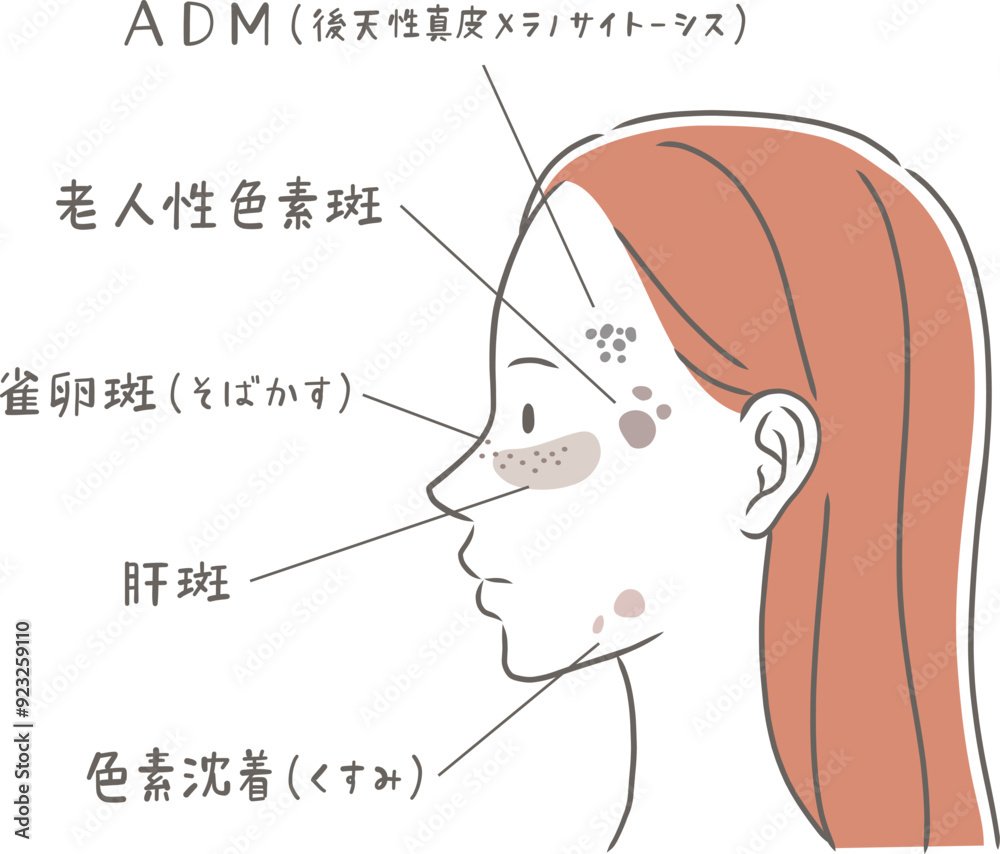 Fototapeta premium シミの種類と横顔の女性のイラスト素材