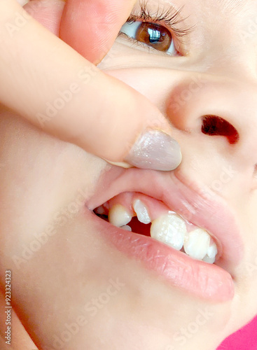 Close-up of the upper jaw and first teeth. The child shows a problematic uneven tooth. Treatment, bite correction, braces. Dentistry concept