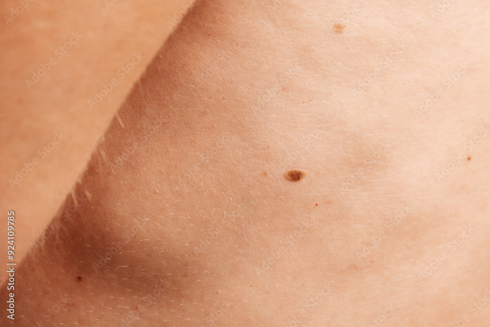 A close-up of a small mole on human skin A close-up of a small mole on human skin