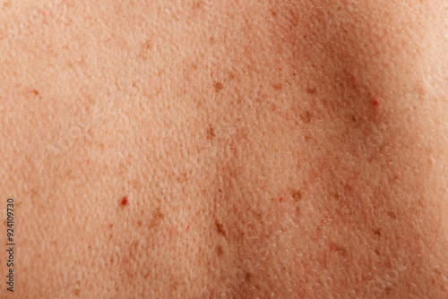 Detailed image of freckles on human skin, focusing on the natural distribution and texture of the freckles.