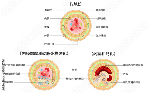 血管閉塞アテローム　中国語 photo