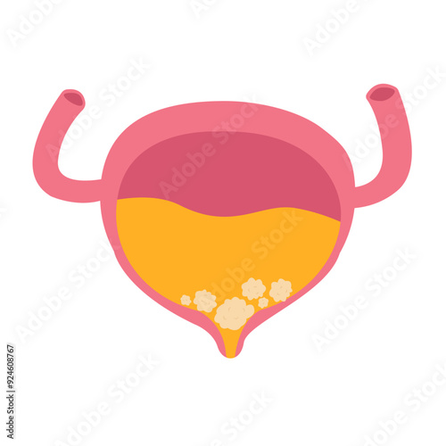 bladder cystitis infection. bladder stone