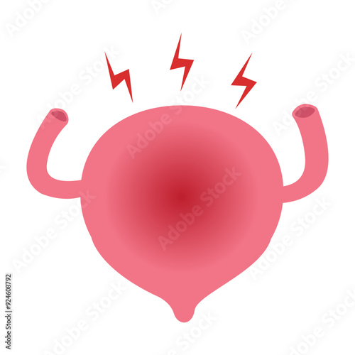 bladder cystitis infection. bladder stone