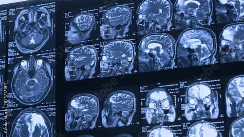 Close-up of CT scan with brain. Medicine, science and education MRI brain background. Magnetic resonance imaging. Tomography shot