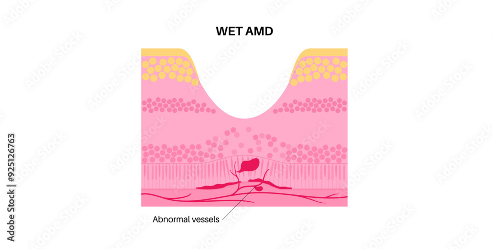 Fototapeta premium Macular degeneration poster