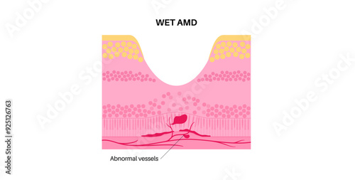 Macular degeneration poster