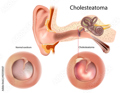 Cholesteatoma and  Normal eardrum. Retracted and perforated eardrum. Otorhinolaryngology Human ear anatomy