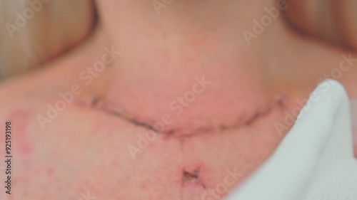 Scar after thyroidectomy. Surgical removal of the thyroid gland.