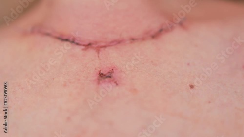Scar after thyroidectomy. Surgical removal of the thyroid gland.