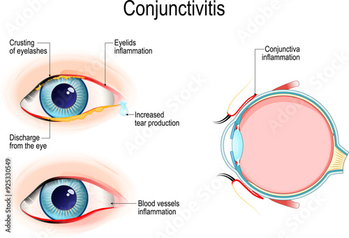 Conjunctivitis. Pink eye. Cross section of a human eye