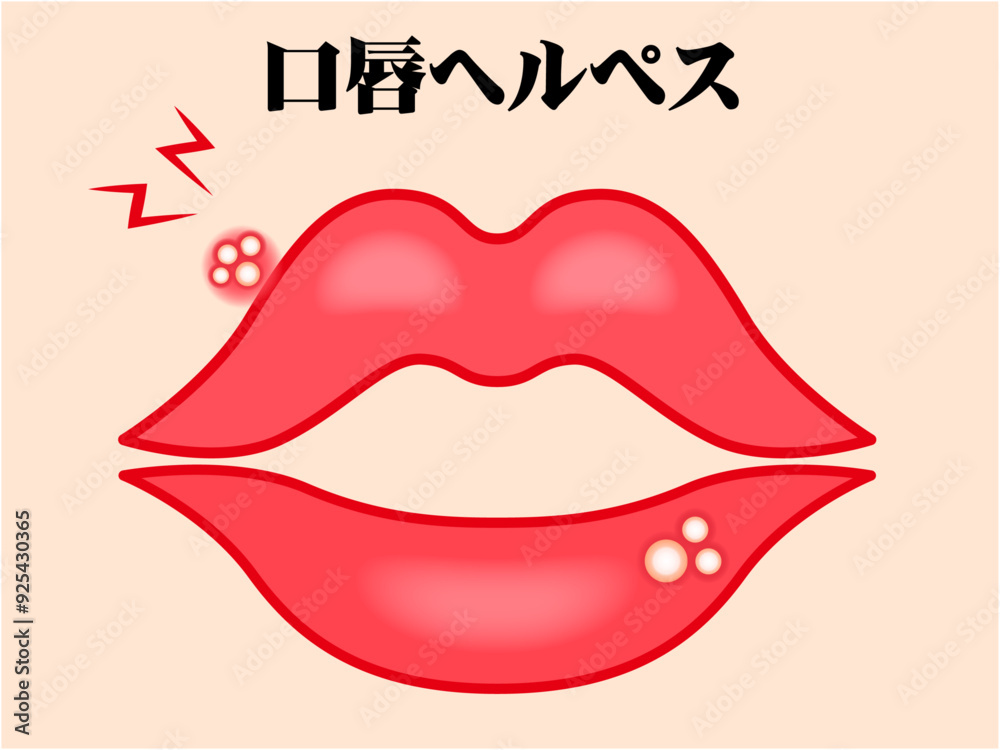 口唇ヘルペスのイラスト素材 口唇ヘルペスのイラスト素材