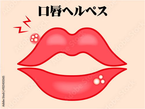 口唇ヘルペスのイラスト素材