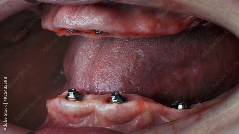 gingival cavity of two jaws with a prosthesis before installing prostheses, side view gingival cavity of two jaws with a prosthesis before installing prostheses, side view