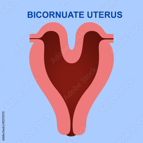 Bicornuate uterus is a congenital malformation that occurs when the uterus divides into two parts